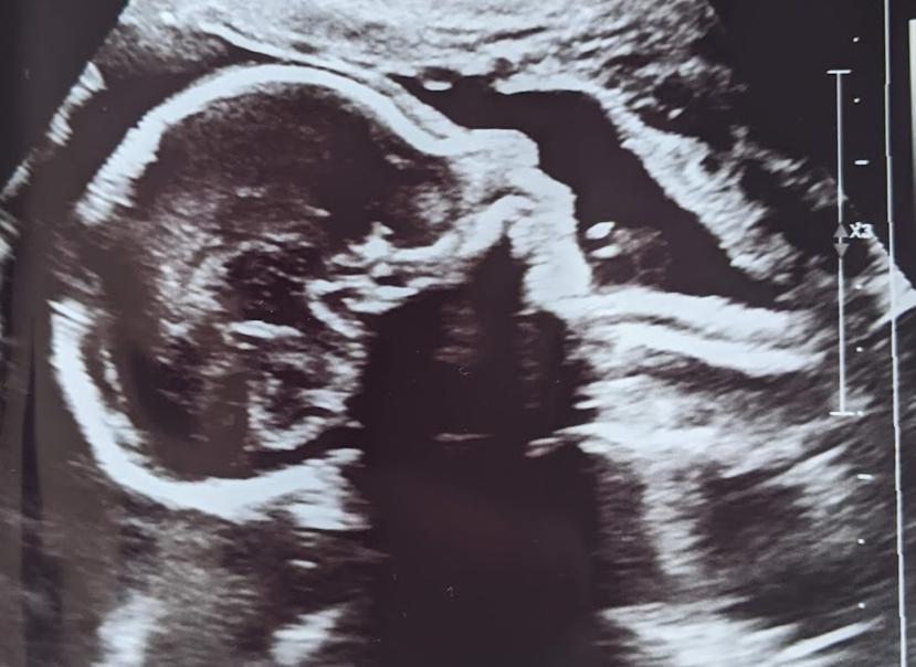 20 Week Ultrasound
